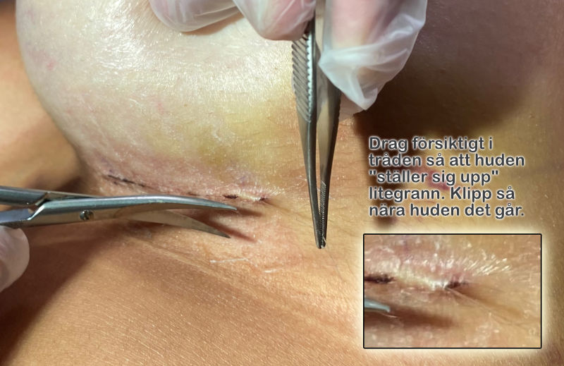visar hur man klipper en tråd efter en bröstoperation