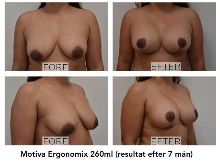bröstlyft med implantat motiva Ergonomix Johan Thorfinn