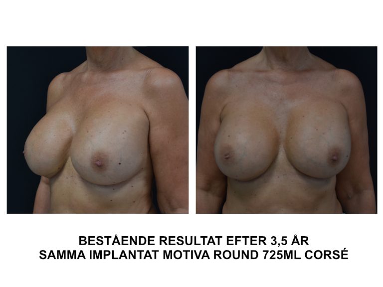efterbild implantatbyte byte tillmotiva round corse bröstimplantat Johan Thorfinn