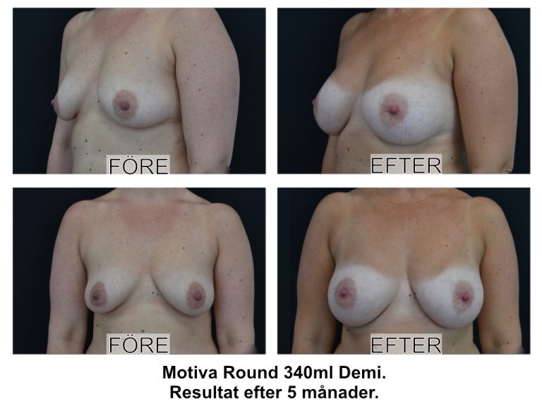 före och efterbild bröstförstoring med motiva round 340ml demi johan thorfinn