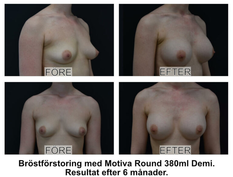 Bröstförstoring med Motiva Round 380ml Demi bakom muskeln Johan Thorfinn Plastikguiden RSD380Qid