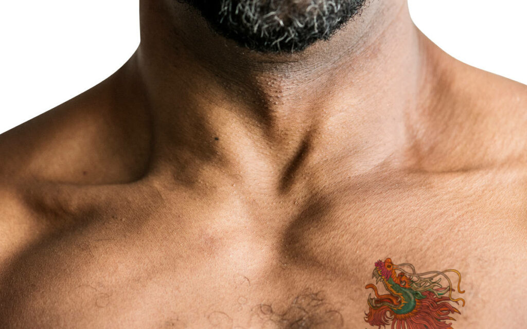 fettsugning av bröst på en man som har gynekomasti chipstuttar man boobs