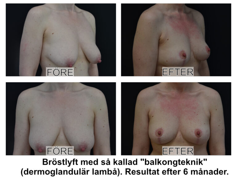 Bröstlyft av Johan Thorfinn på Plastikakademin i Linköping