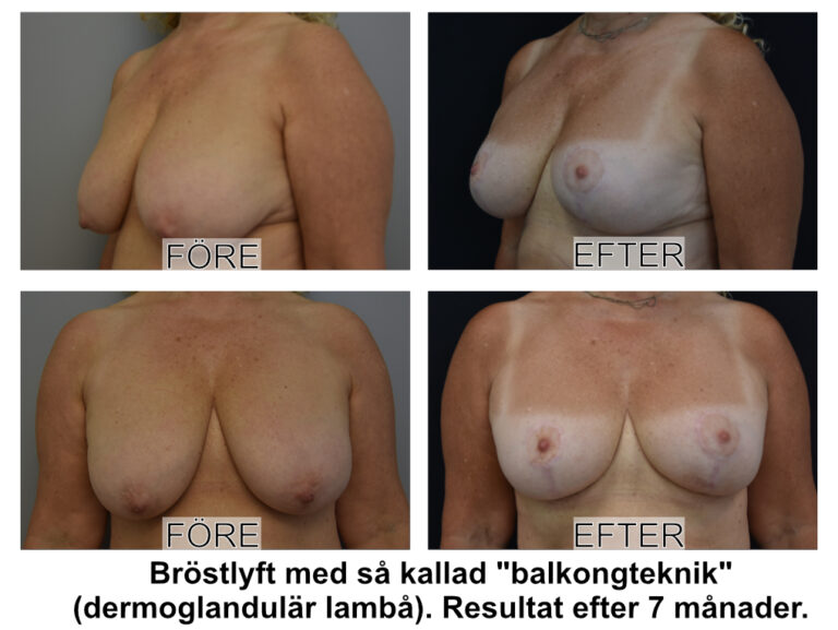 Före- och efterbild på plastikkirurgiskt bröstlyft (mastopexi) utförd av Plastikguiden Johan Thorfinn på Plastikakademin i Linköping.
