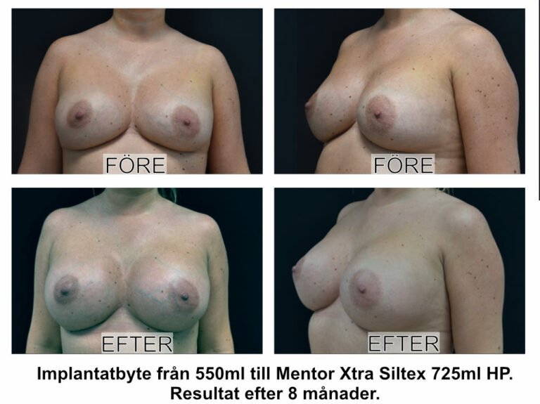 byte av bröstimplantat från 550ml till mentor xtra Siltex 725ml operation av Johan Thorfinn plastikguiden