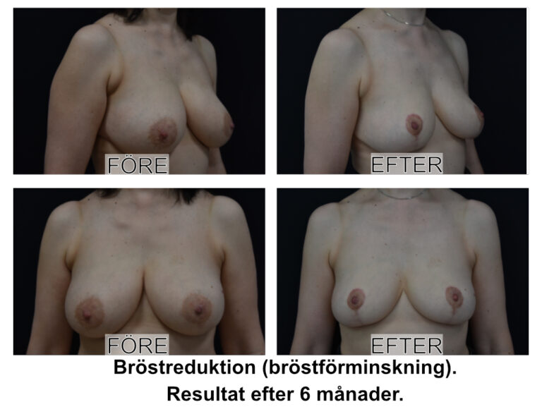 Patient som har gjort bröstförminskning (bröstreduktion) utförd av Johan Thorfinn Plastikguiden på Plastikakademin i Linköping.