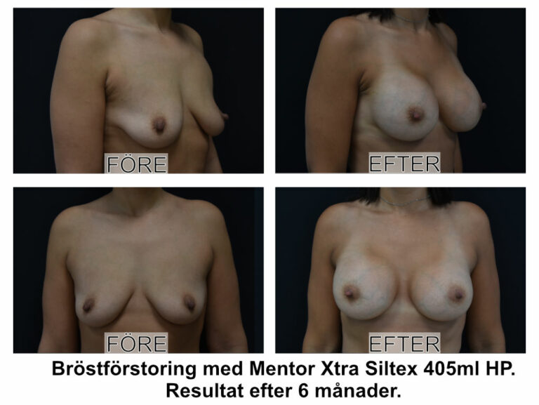 Bröstförstoring av Johan Thorfinn med Mentor Xtra SIltex 405ml High Profile hög profil silikonimplantat dualplane